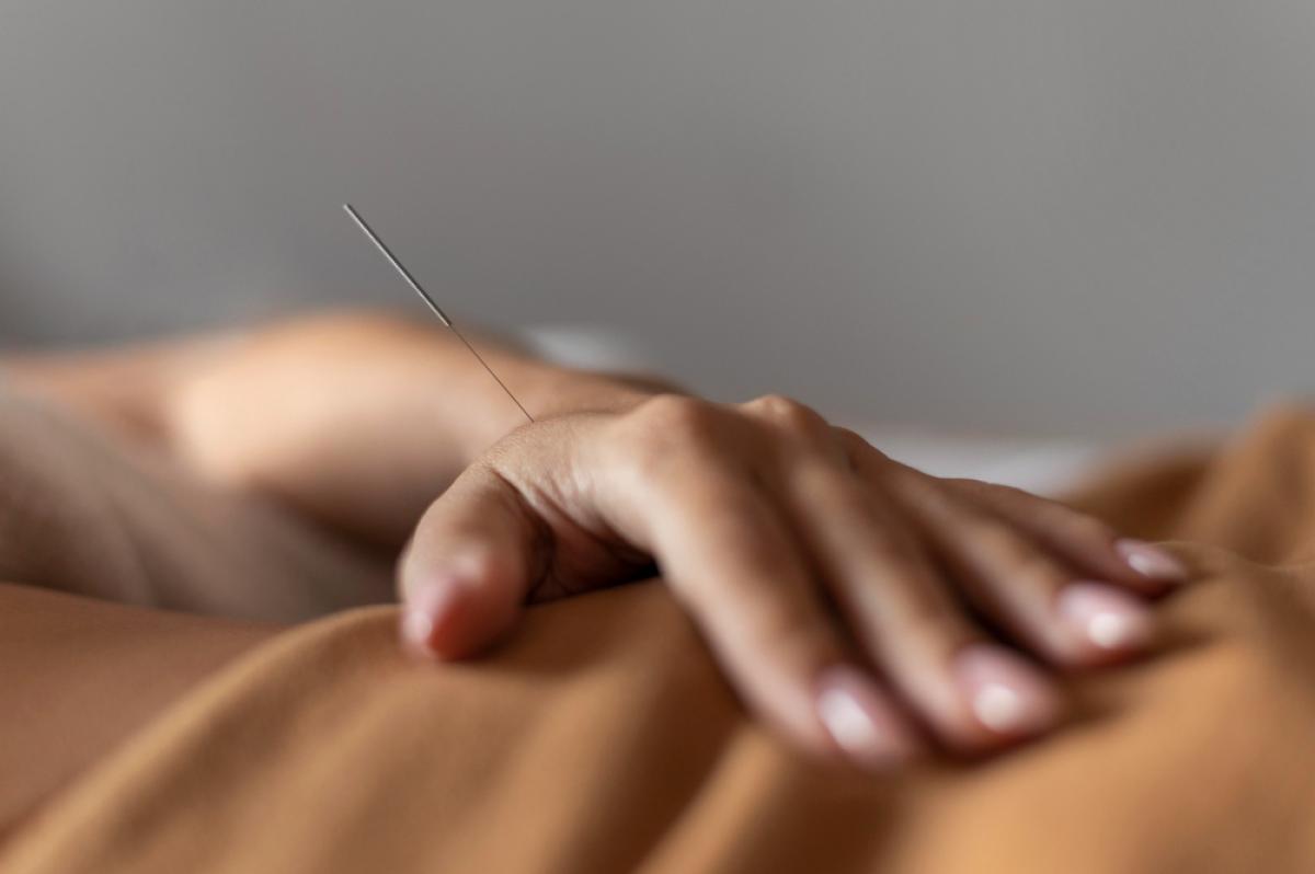 Acupuncture